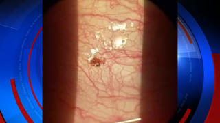 Illustration for article titled Acude al médico por una irritación en el ojo y le encuentran una garrapata en el globo ocular